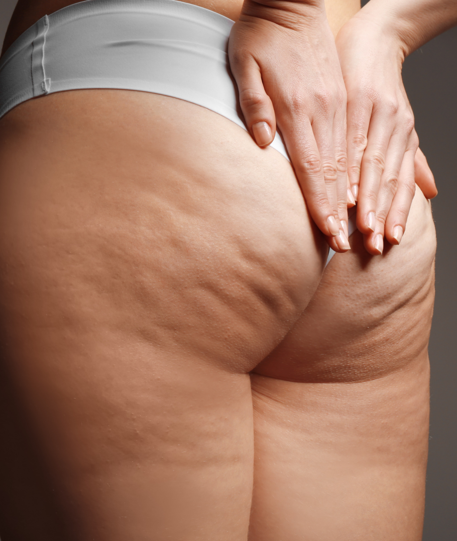 Cellulite on a woman's buttocks